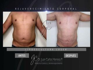 Lipoescultura