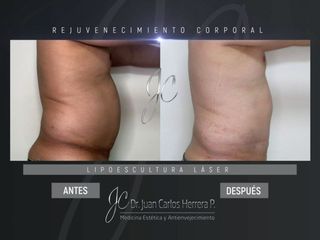 Lipoescultura