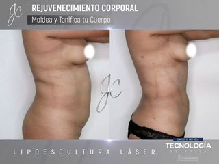 Lipoescultura
