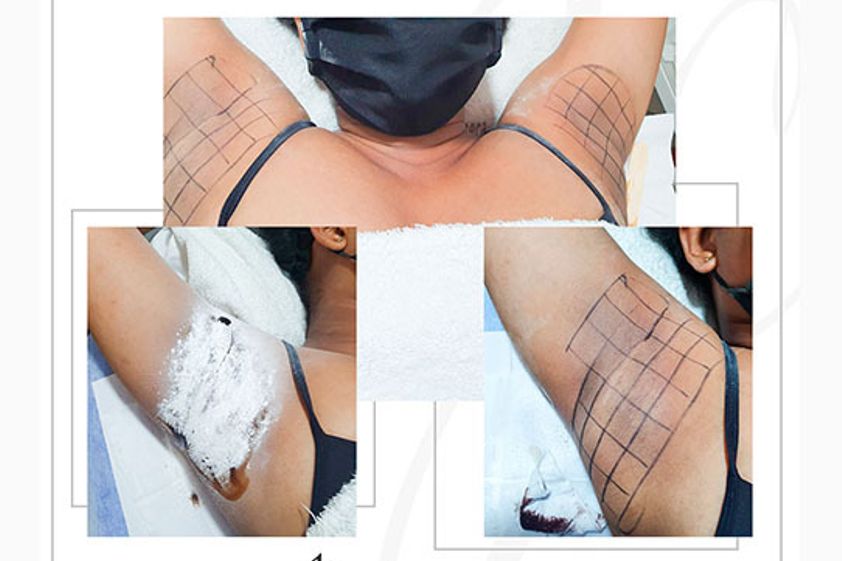 Hiperhidrosis antes y después - 699166