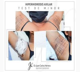 Hiperidrosis Axilar - Dr. Juan Carlos Herrera P.