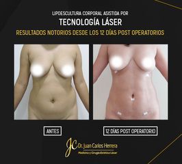 Resultados de una Lipoescultura