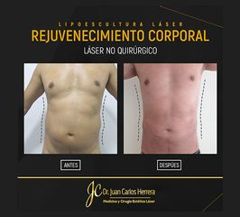 Lipolisis Láser - Dr. Juan Carlos Herrera P.