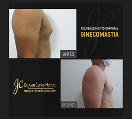 Resultados de una Ginecomastia - Dr. Juan Carlos Herrera P.