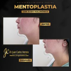 Mentoplastia - Dr. Juan Carlos Herrera P.