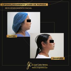 Cirugía papada - Dr. Juan Carlos Herrera P.