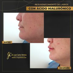 Aumento de labios - Dr. Juan Carlos Herrera P.