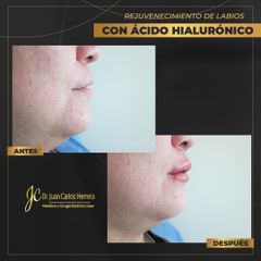 Rejuvenecimiento de labios - Dr. Juan Carlos Herrera P.
