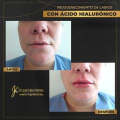 Aumento de labios - Dr. Juan Carlos Herrera P.