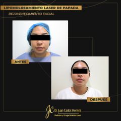 Lipomoldeamiento de papada - Dr. Juan Carlos Herrera P.