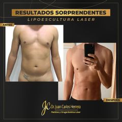 Lipoescultira láser - Dr. Juan Carlos Herrera P.