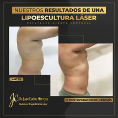 Lipoescultura - Dr. Juan Carlos Herrera P.