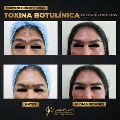 Toxina Botulínica - Dr. Juan Carlos Herrera P.