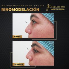 Rinomodelación - Dr. Juan Carlos Herrera P.