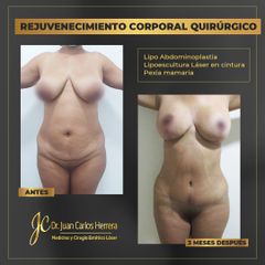 Lipoescultura - Dr. Juan Carlos Herrera P.