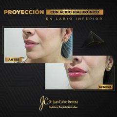 Aumento de labios -  Dr. Juan Carlos Herrera P.
