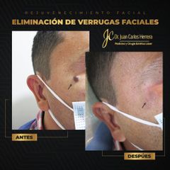 Eliminación de verrugas - Dr. Juan Carlos Herrera P.