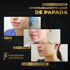 Lipomoldeamiento laser de papada - Dr. Juan Carlos Herrera P.