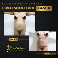Lipoescultura - Dr. Juan Carlos Herrera P.