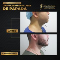 Cirugía de papada - Dr. Juan Carlos Herrera P.
