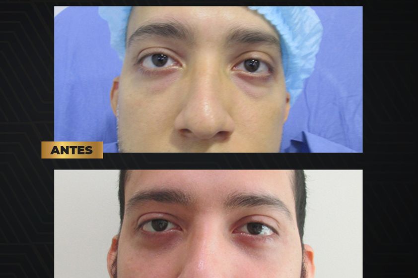 Blefaroplastia antes y después - 819700