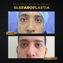 Blefaroplastia - Dr. Juan Carlos Herrera P.