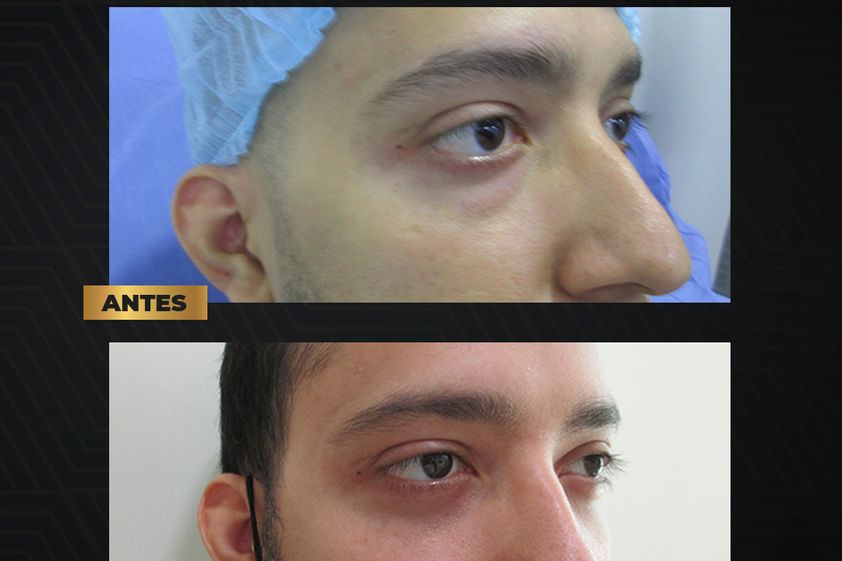Blefaroplastia antes y después - 819702