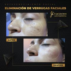 Verrugas - Dr. Juan Carlos Herrera P.