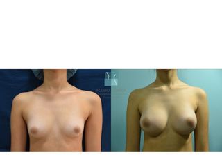 PRE-POS DE MAMOPLASTIA DE AUMENTO