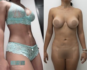 lipomarcacion abdominal