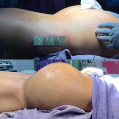 lipoinyeccion y moldeamiento de gluteos 
