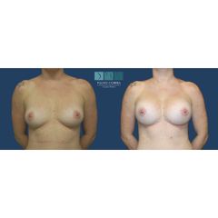 mamoplastia de aumento 330cc