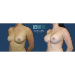 mamoplastia de aumento