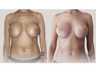Liposucción + Mastopexia - Dr Fulvio Alexander Correa