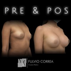 Aumento mamario - Dr Fulvio Alexander Correa