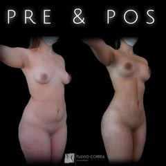 Liposucción y aumento mamario - Dr Fulvio Alexander Correa