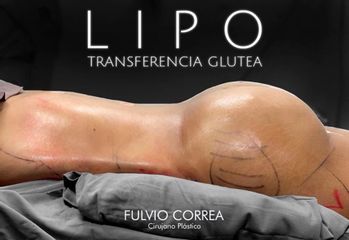 Lipotransferencia glúitea - Dr Fulvio Alexander Correa