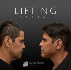 Lifting facial - Dr Fulvio Alexander Correa
