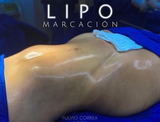 Lipomarcación - Dr Fulvio Alexander Correa