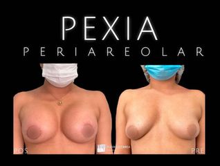 Pexia periareolar - Dr Fulvio Alexander Correa