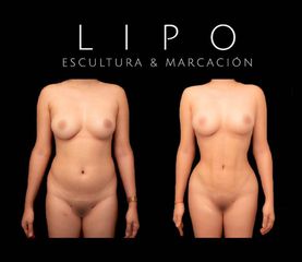 Lipoescultura - Dr Fulvio Alexander Correa