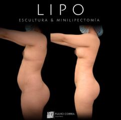 Lipomarcación y aumento mamario  - Dr Fulvio Alexander Correa