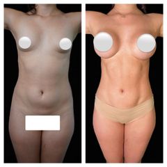 Liposucción - Dr Fulvio Alexander Correa