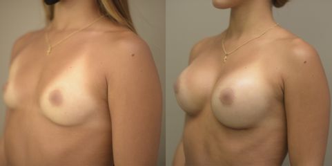 Mamoplastia de aumento - Dr Fulvio Alexander Correa