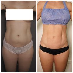 Liposucción - Dr Fulvio Alexander Correa