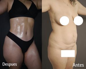 Lipoabdominoplastia - Dr Fulvio Alexander Correa