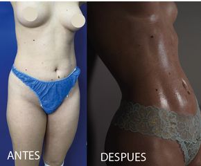 Liposucción - Dr Fulvio Alexander Correa