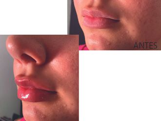 Aumento de labios - 859200