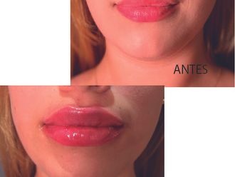 Aumento de labios - 859201