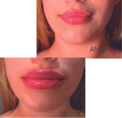 Aumento de labios - Dr Fulvio Alexander Correa